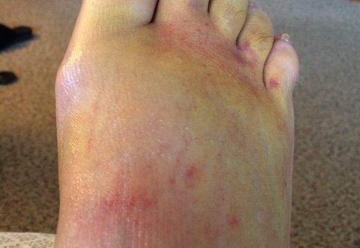 My bruising is a lovely shade of yellow. #thefoot #broken